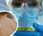 Documenti Ufficiali del Governo Indicano che il Vaiolo delle Scimmie è una Cortina di Fumo per Nascondere il Fatto che i Vaccini Covid Causano Immunodeficienza